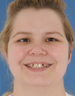 Stefanie's Zahnspange vorher