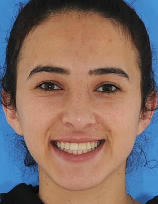 Nesrin's Zahnspange nachher
