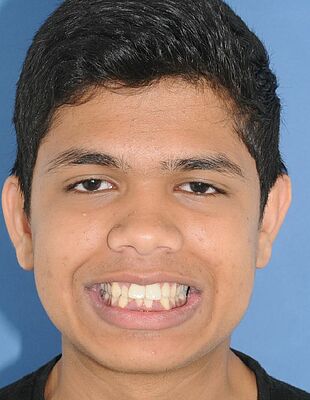 Ridoy's Zahnspange vorher