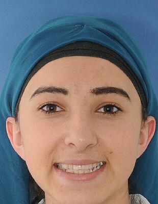 Nesrin's Zahnspange vorher