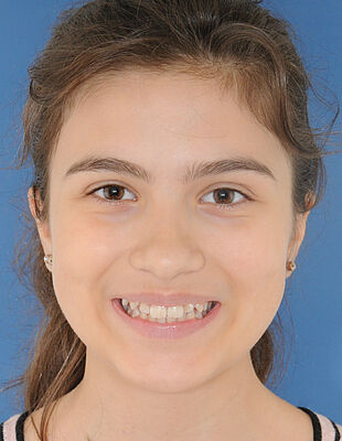 Jaqueline's Zahnspange vorher