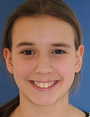 Nina's Zahnspange vorher