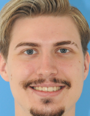Rene's Zahnspange nachher