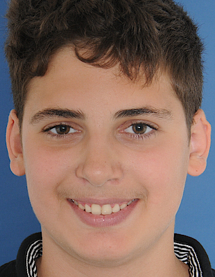 Florian's Zahnspange nachher