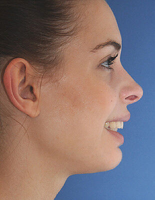 Nina's Zahnspange vorher