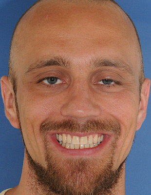 Martin's Zahnspange nachher