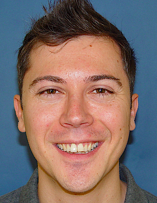 Robert's Zahnspange vorher