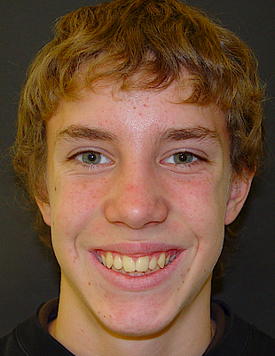 Sascha's Zahnspange vorher