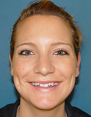Tanja's Zahnspange vorher