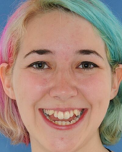 Anna's Zahnspange vorher