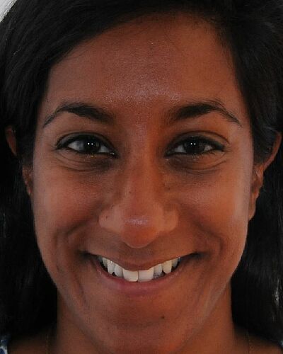 Himali's Zahnspange vorher