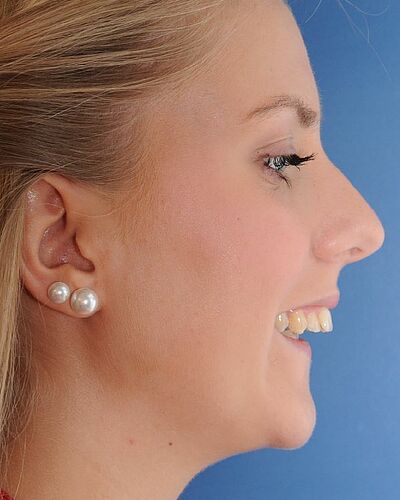 Janine's Zahnspange vorher