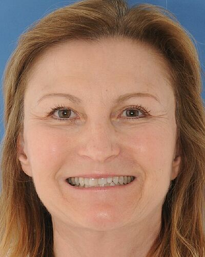 Jutta's Zahnspange vorher