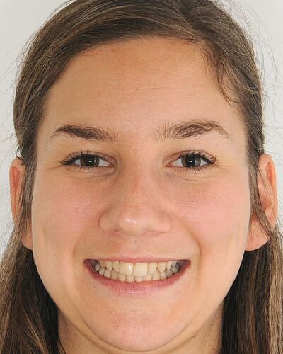 Katharina's Zahnspange vorher