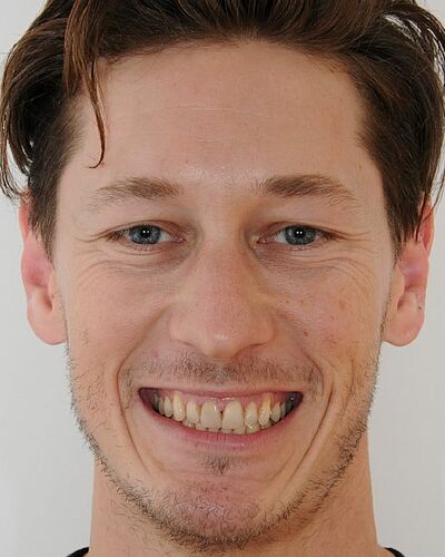 Lucas's Zahnspange nachher