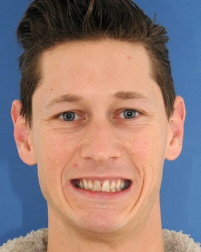 Lucas's Zahnspange vorher