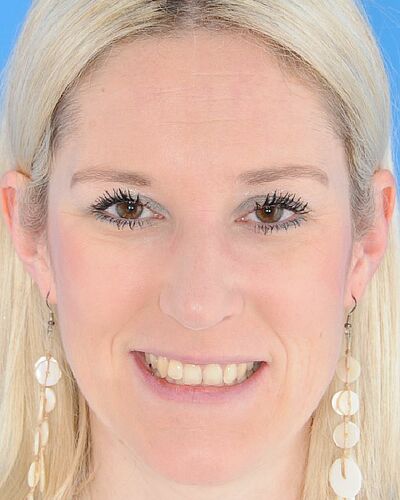 Sonja's Zahnspange vorher
